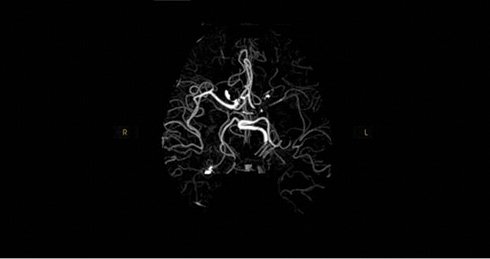 FDA: принят программное обеспечение для автоматического анализа КТ-изображений при подозрении на окклюзию мозговых артерий