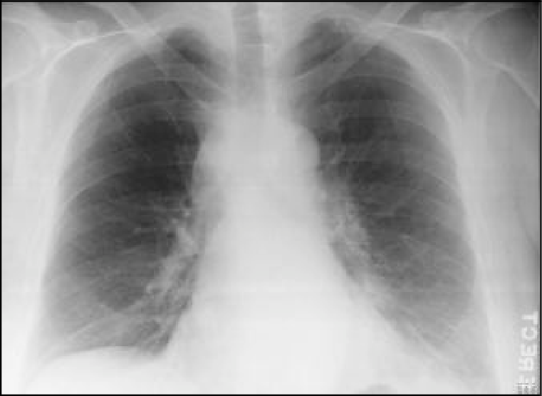 "рентген ОГК легенева форма сибірки"