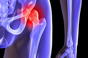 Применение варфарина и риск протезирования коленных и тазобедренных суставов