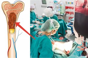 Трансплантация костного мозга: Минздрав планирует провести в Украине 480 таких процедур в течение 2021