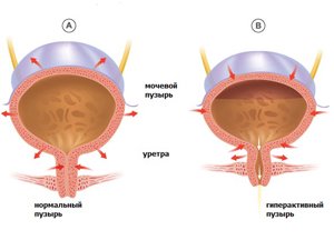 Недержание мочи у женщин.  эффективность лечения