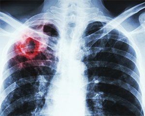 Как отличить туберкулез от COVID-19