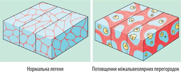 COVID-19: возможности УЗИ при обследовании легких у инфицированных пациентов