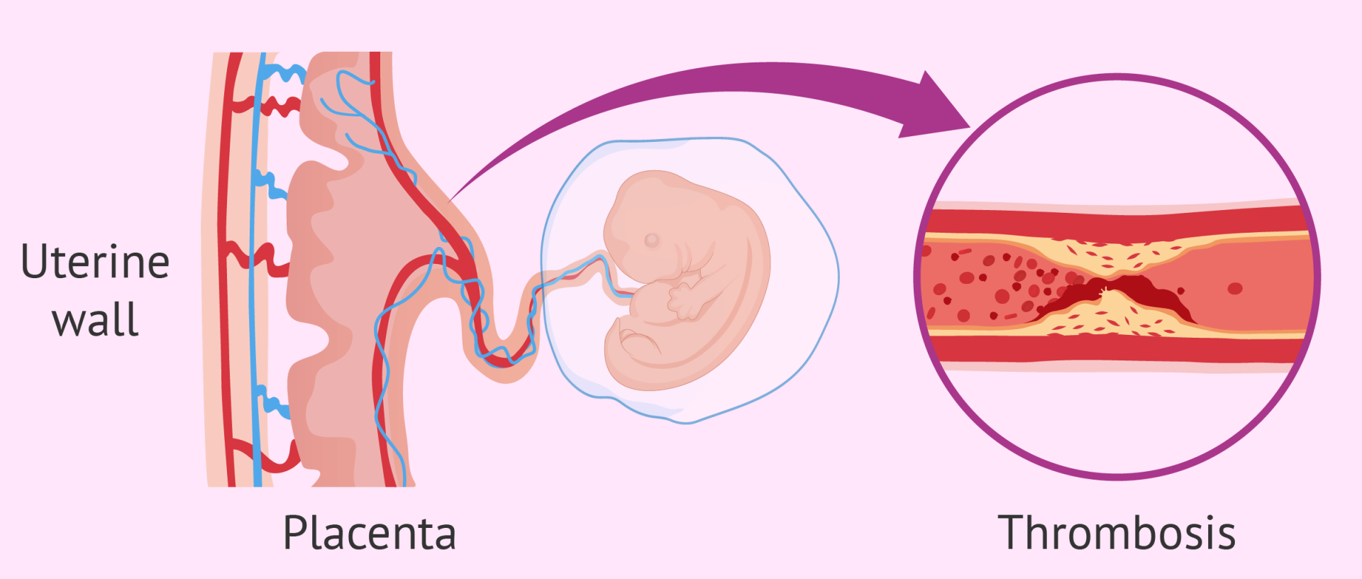 Афс синдром. АФС И беременность. Антифосфолипидный синдром. Antiphospholipid Syndrome pregnancy.