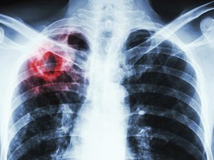 Сопровождение и лечения больных туберкулезом на первичном звене