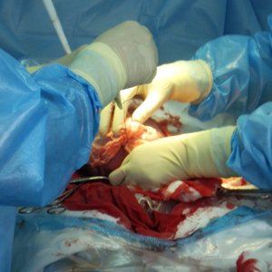 В Украине впервые осуществлен трансплантацию трем пациентам от одного донора
