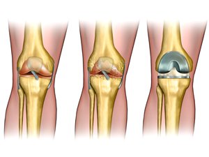 Замена коленных суставов.  Как уменьшить ПЕРИОПЕРАЦИОННОЙ кровотечение?